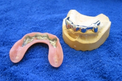 Dentallabor Feldmann - Titan - Stegarbeit gaumenfrei - Bild 2