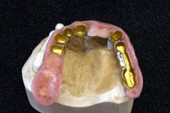 Dentallabor Feldmann - Galvanokronen - Teleskoparbeit mit Steg auf Implantat - Bild 9