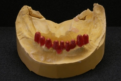 Dentallabor Feldmann - Teleskoparbeit mit Zirkon-Primärteilen und Galvanotechnik - Bild 1