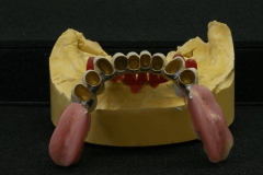 Dentallabor Feldmann - Teleskoparbeit mit Zirkon-Primärteilen und Galvanotechnik - Bild 2