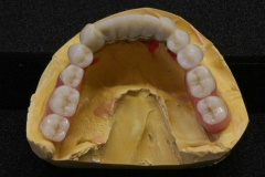 Dentallabor Feldmann - Teleskoparbeit mit Zirkon-Primärteilen und Galvanotechnik - Bild 4