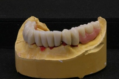 Dentallabor Feldmann - Teleskoparbeit mit Zirkon-Primärteilen und Galvanotechnik - Bild 5