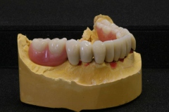 Dentallabor Feldmann - Teleskoparbeit mit Zirkon-Primärteilen und Galvanotechnik - Bild 6
