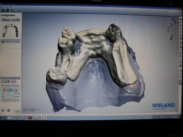 Dentallabor Feldmann - Zahnersatz für Allergiker - Bild 09