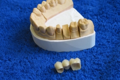 Dentallabor Feldmann - Zirkonkronenbrücke Bild 3